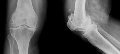 Gonartrosi ai raggi x.