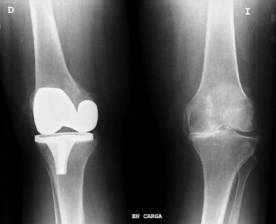 Gonartrosi ai raggi x.